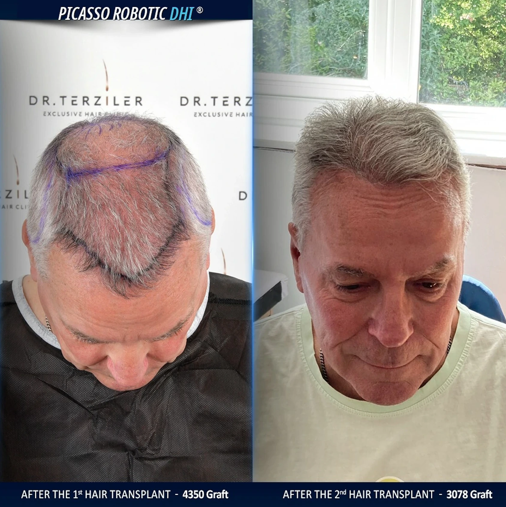 hair transplant gone wrong fixed at Dr. Terziler Exclusive Clinic