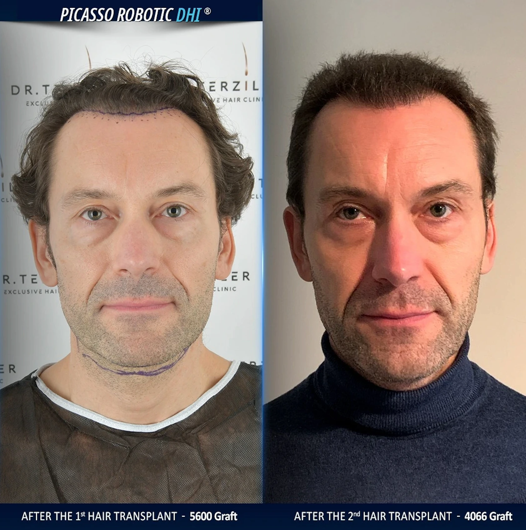 bad hair transplant repair at the best hair transplant Clinic, Dr. Terziler.
