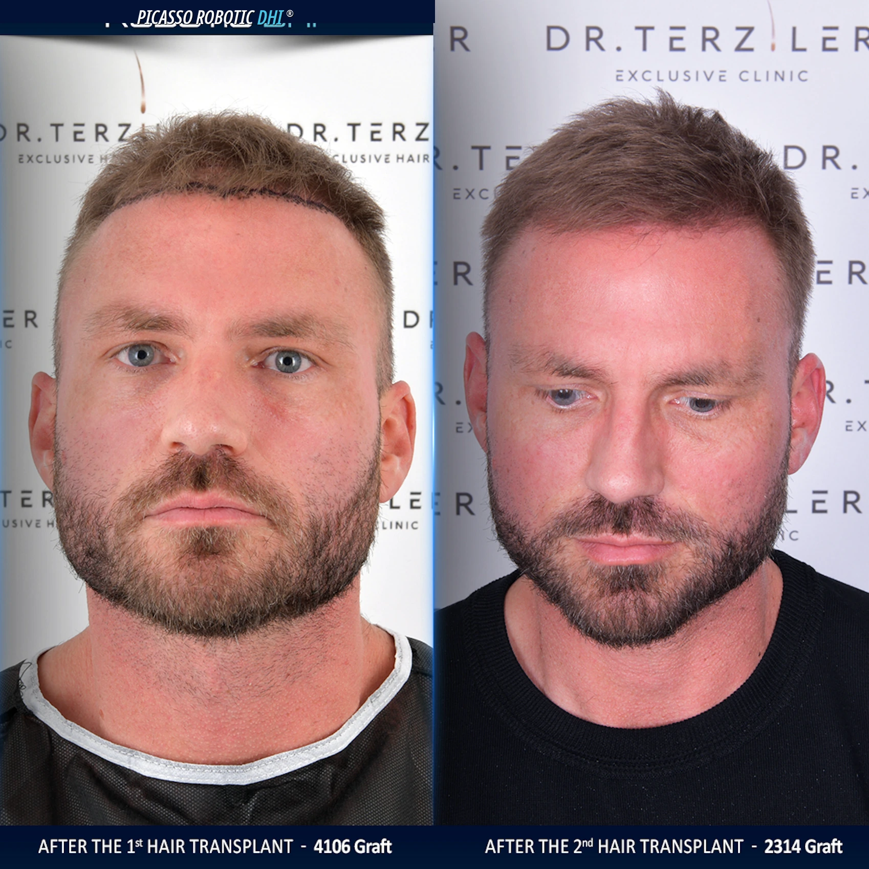 real patient hair transplant gone wrong repair pictures