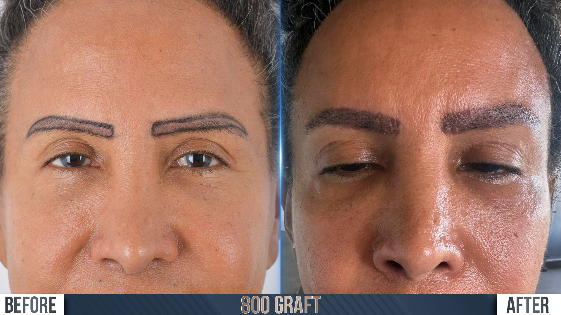 Eyebrow transplant before and after results, front view, Month 9-10 ‚Äî Dr. Terziler Istanbul