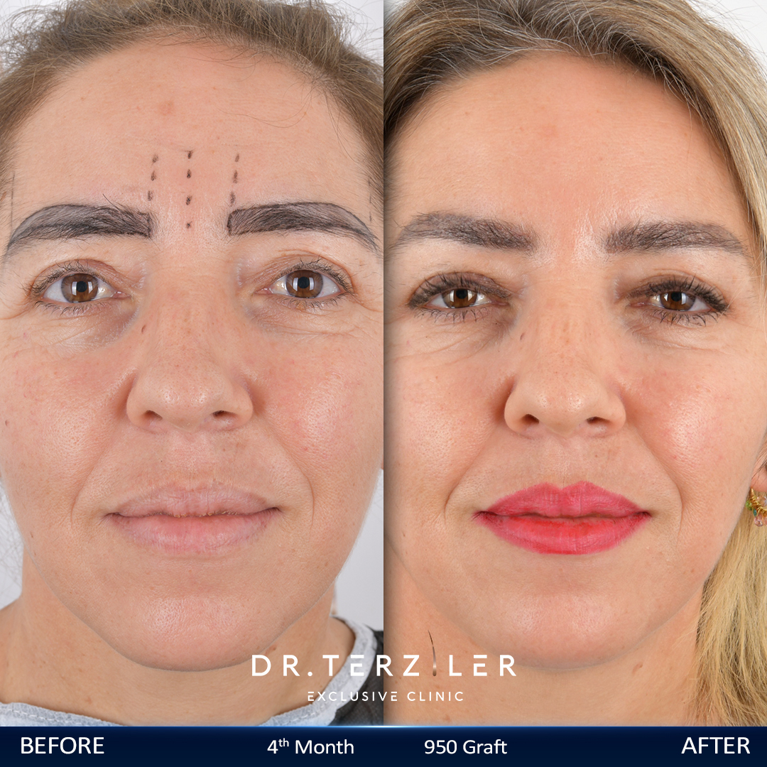 Eyebrow transplant before and after results, 45-degree angle view, Month 9-10 ‚Äî Dr. Terziler Istanbul
