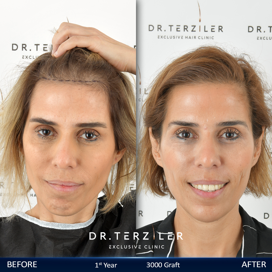 Female hair transplant before and after results, Patient 1, Month 12 ‚Äî Dr. Terziler Istanbul