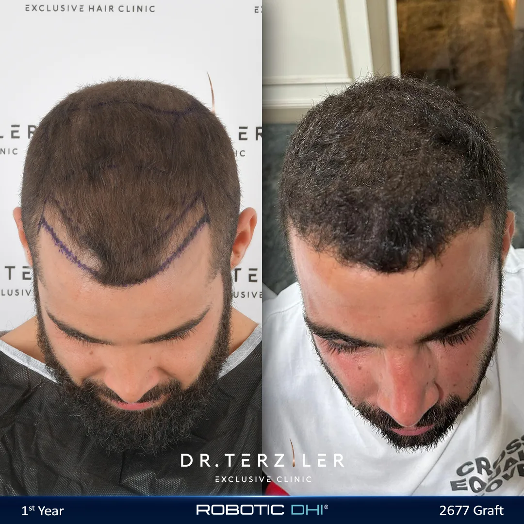 2000 grafts hair transplant patient before after at the best hair transplant clinic in Turkey Dr. Terziler