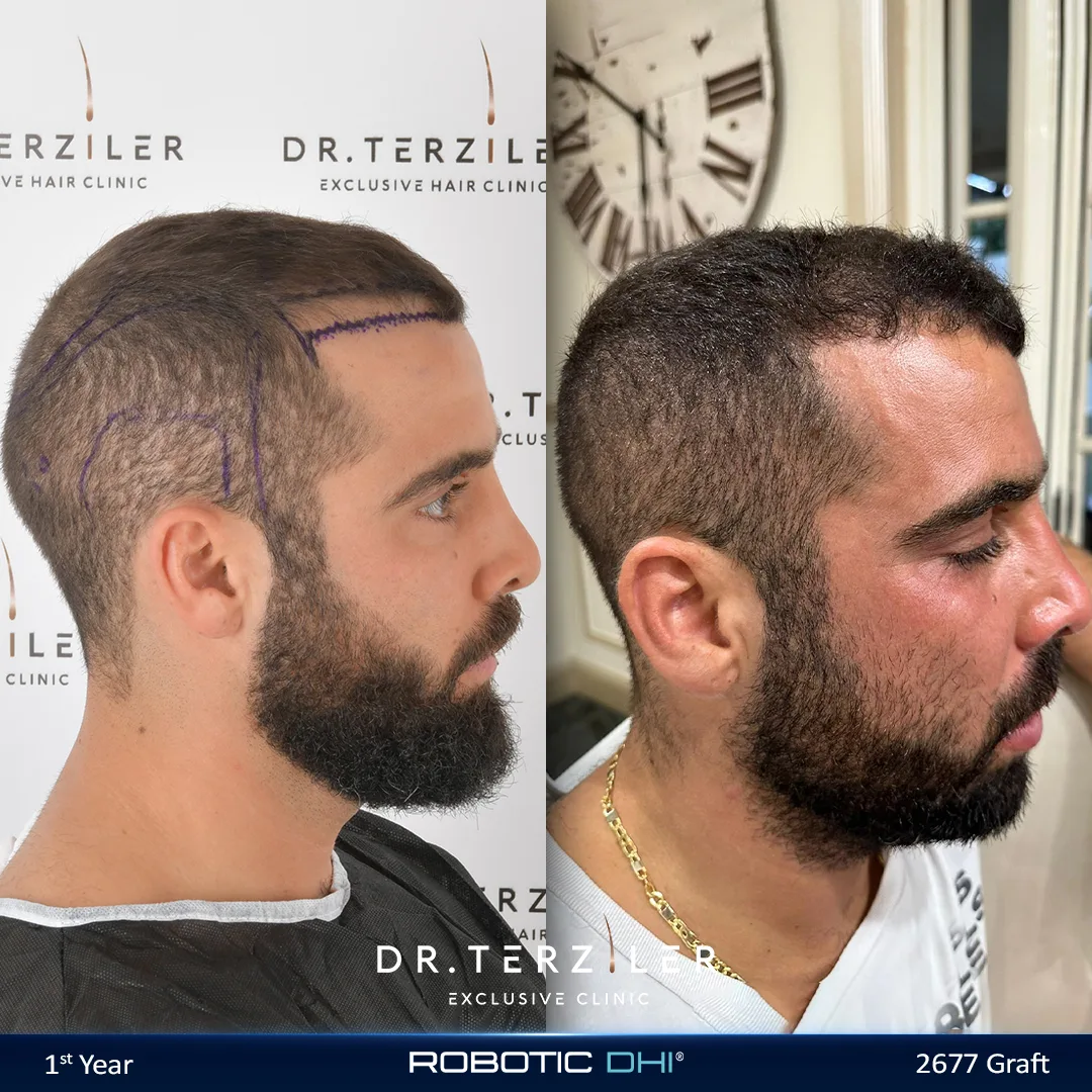 2000 graft hair transplant patient before after side photo at the best hair transplant clinic in Turkey Dr. Terziler