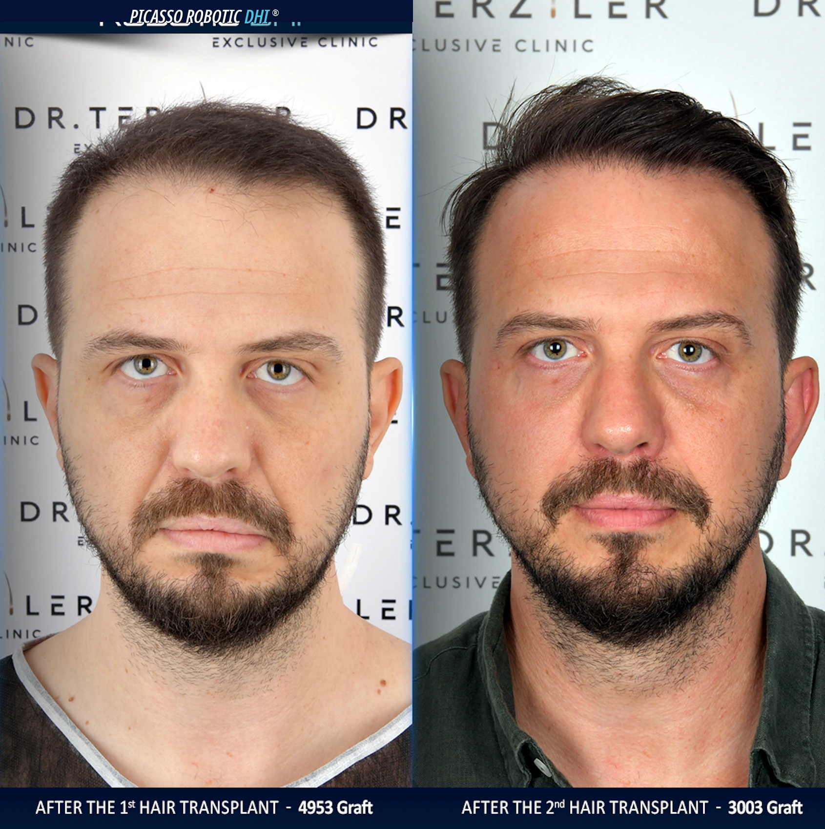 real patient failed hair transplant repair case studies