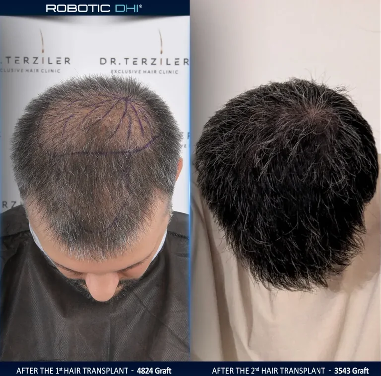 Failed hair transplant repair before and after, crown view comparison, Month 12 ‚Äî Robotic DHI, Dr. Terziler Istanbul