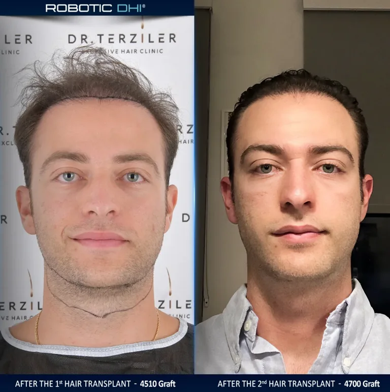 Failed hair transplant repair before and after, front view comparison, Month 12 ‚Äî Robotic DHI, Dr. Terziler Istanbul