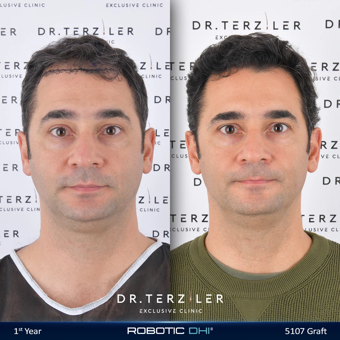 Robotic DHI hair transplant before and after results, Patient 1 front view, Month 12 ‚Äî Dr. Terziler Istanbul