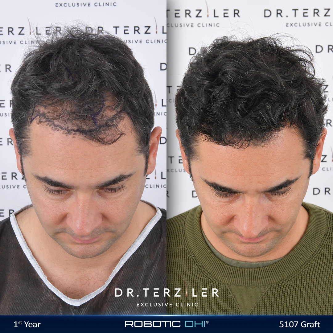 Robotic DHI hair transplant before and after results, Patient 1 crown view, Month 12 ‚Äî Dr. Terziler Istanbul