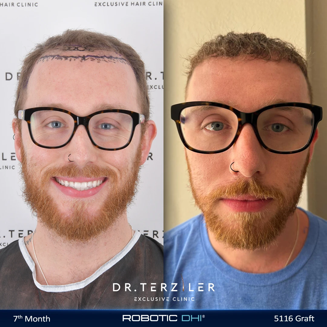 Robotic DHI hair transplant before and after results, Patient 2 front view, Month 12 ‚Äî Dr. Terziler Istanbul