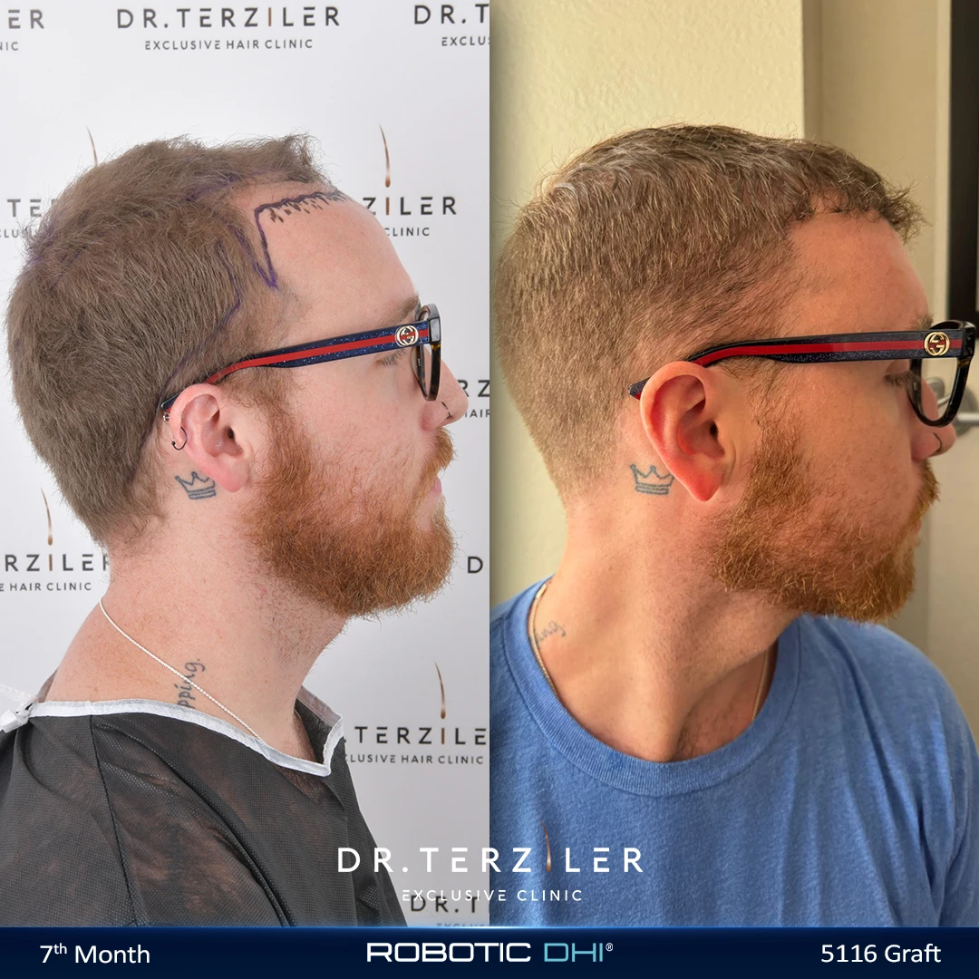 Robotic DHI hair transplant before and after results, Patient 2 right side view, Month 12 ‚Äî Dr. Terziler Istanbul