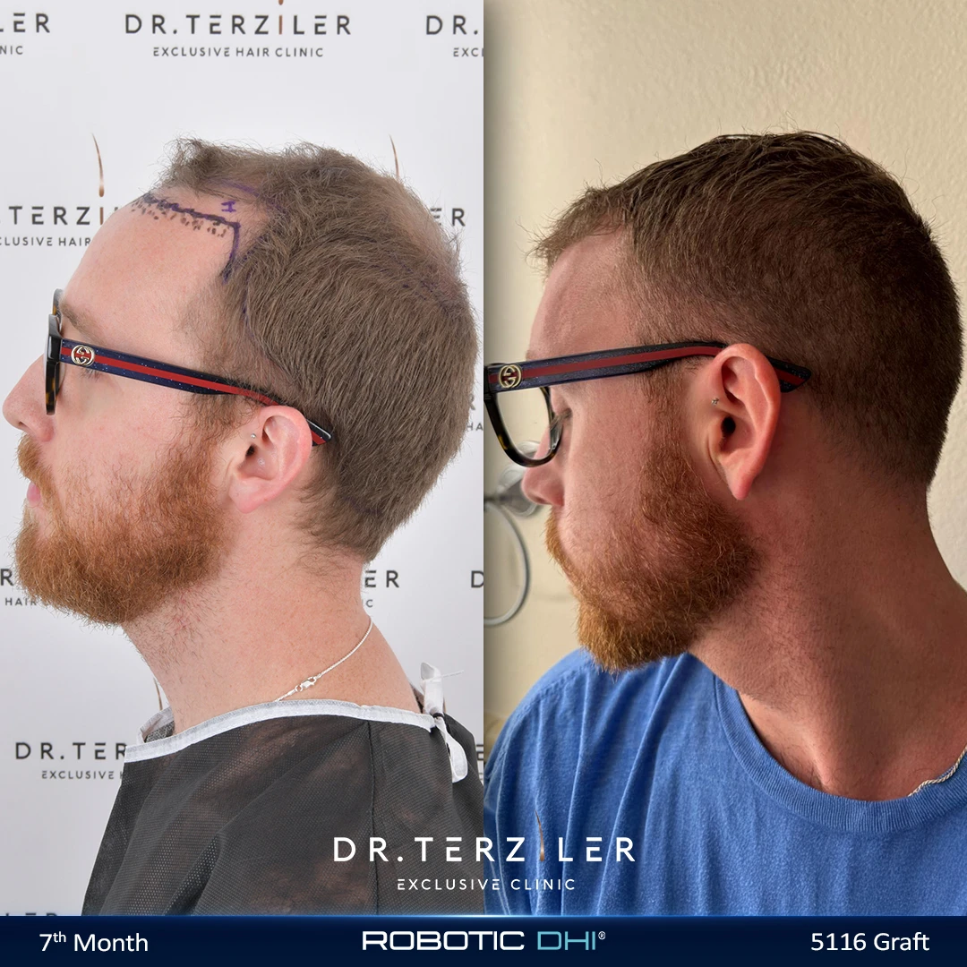 Robotic DHI hair transplant before and after results, Patient 2 left side view, Month 12 ‚Äî Dr. Terziler Istanbul