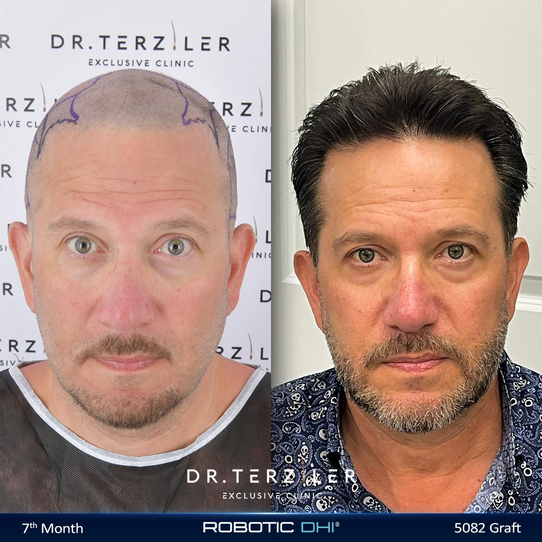 Robotic DHI hair transplant before and after results, Patient 3 front view, Month 12 ‚Äî Dr. Terziler Istanbul