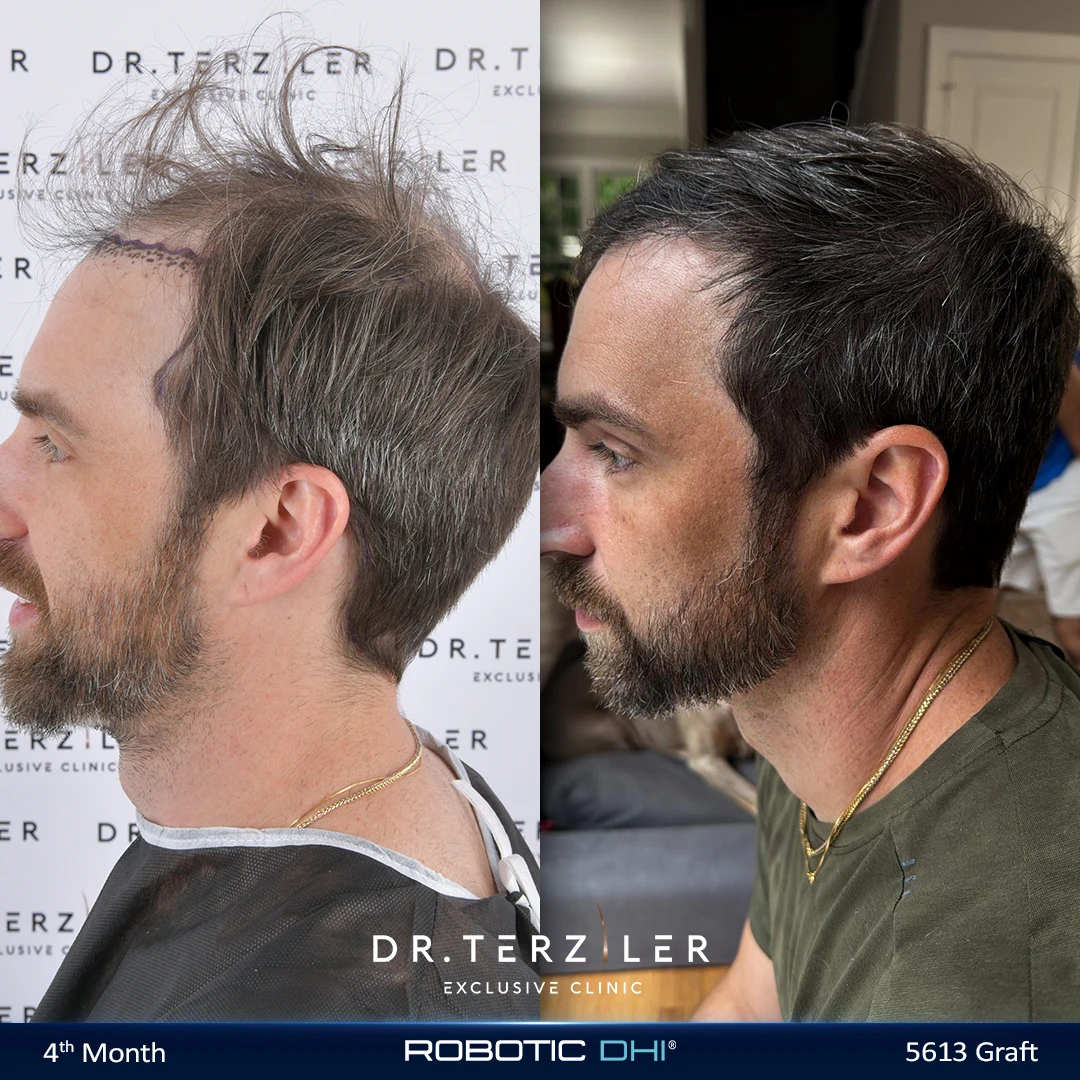 Robotic DHI hair transplant before and after results, Patient 4 left side view, Month 12 ‚Äî Dr. Terziler Istanbul