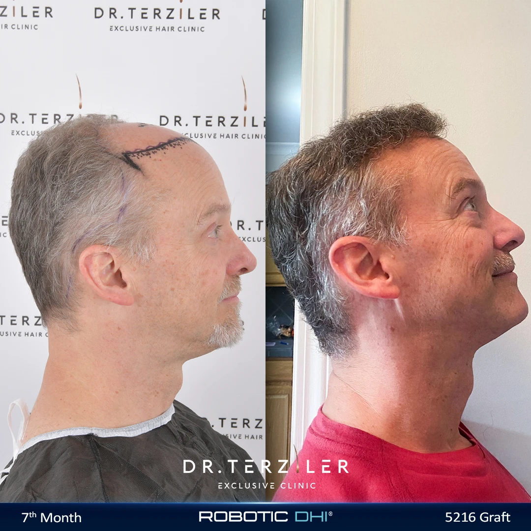 Robotic DHI hair transplant before and after results, Patient 5 right side view, Month 12 ‚Äî Dr. Terziler Istanbul