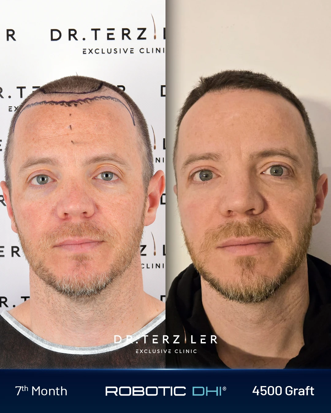 Robotic DHI hair transplant before and after results, Patient 6 front view, Month 12 ‚Äî Dr. Terziler Istanbul