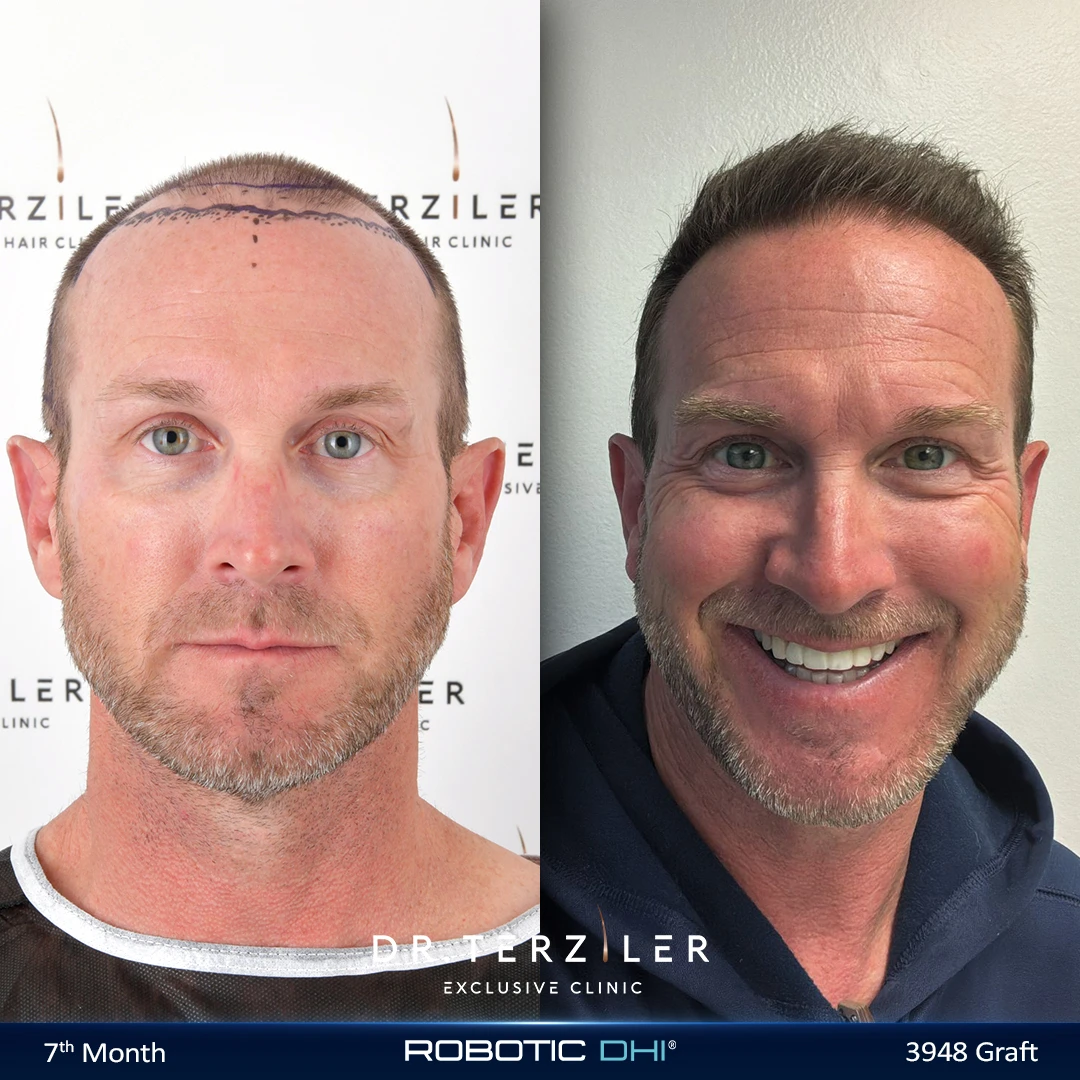 Robotic DHI hair transplant before and after results, Patient 7 front view, Month 12 ‚Äî Dr. Terziler Istanbul