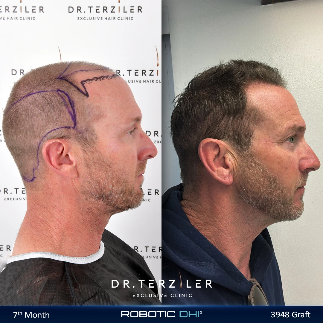 Robotic DHI hair transplant before and after results, Patient 7 right side view, Month 12 ‚Äî Dr. Terziler Istanbul