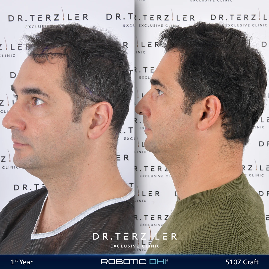 Robotic DHI hair transplant before and after results, Patient 1 side view, Month 12 ‚Äî Dr. Terziler Istanbul