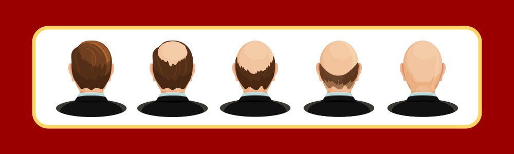 Can Genetic Hair Loss Be Completely Stopped with a Hair Transplant?