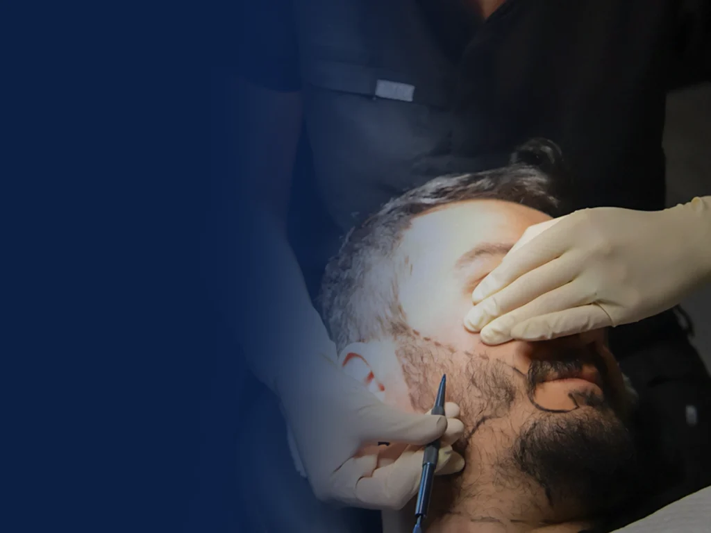 Implante de barba, bigote y patillas