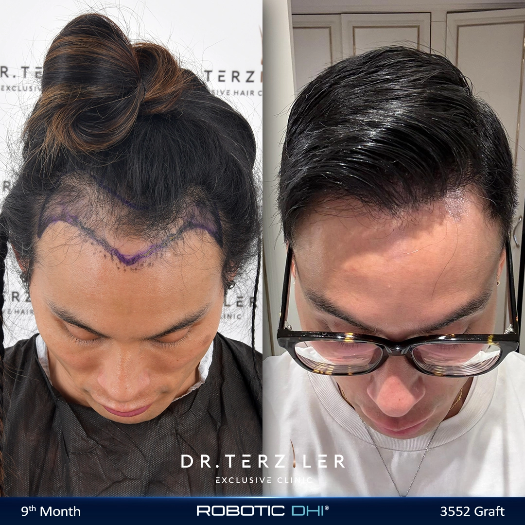 risultato linea frontale trapianto capelli 3000 innesti Dr. Terziler Turchia