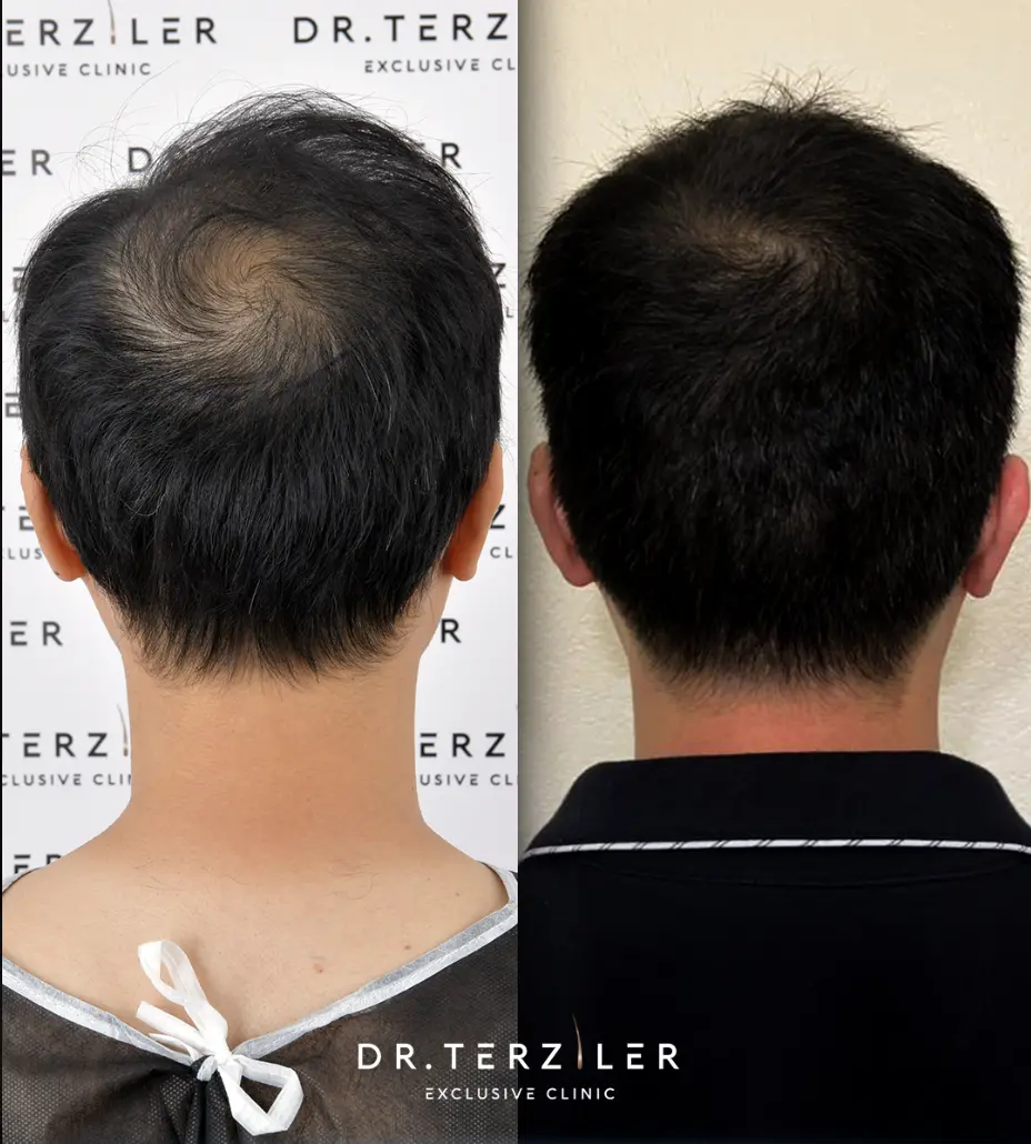 trapianto corona 3000 innesti prima dopo Dr. Terziler Istanbul
