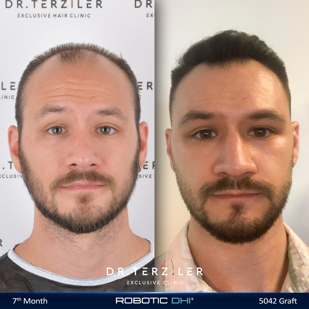Résultat naturel après greffe de cheveux 5000 greffons Robotic DHI