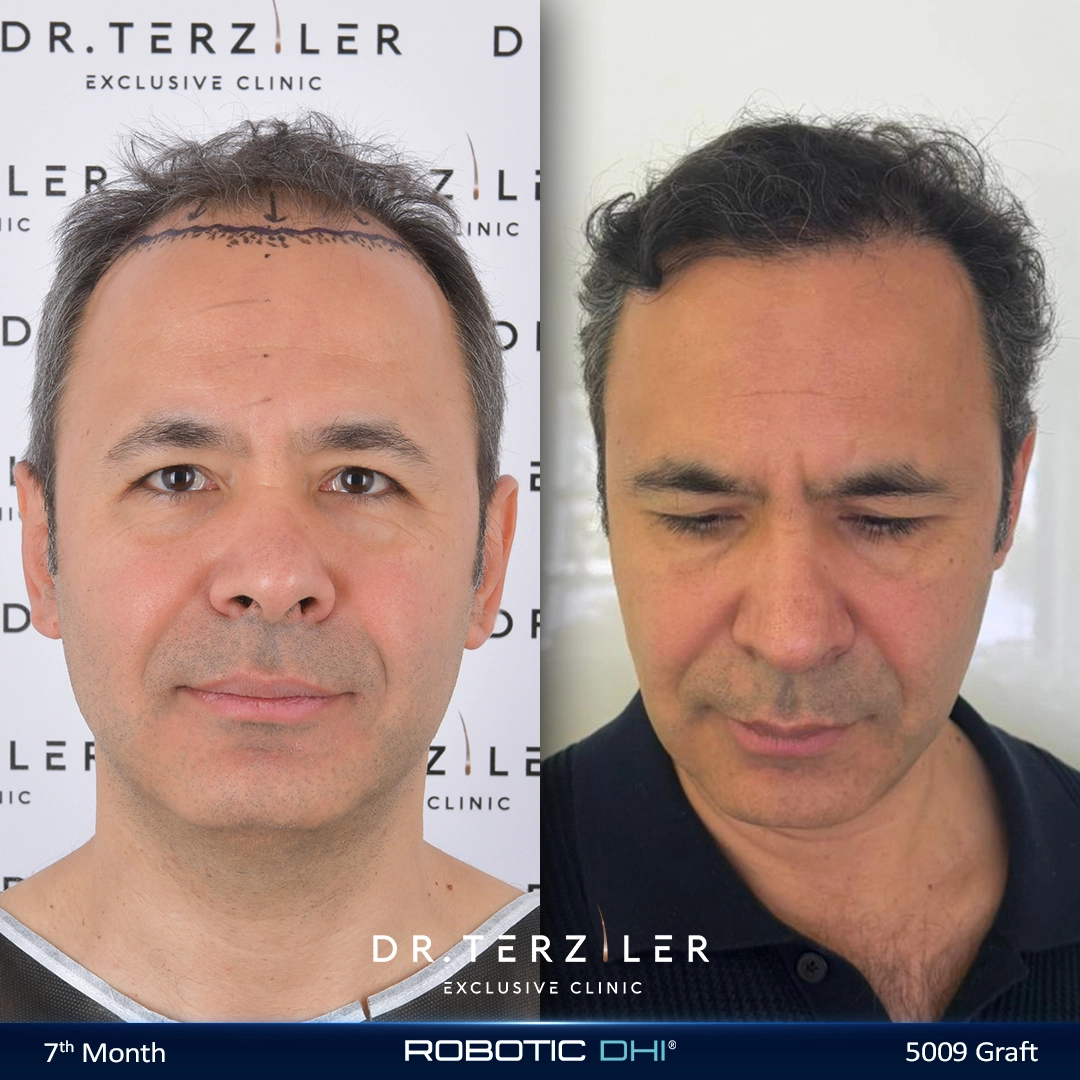 Greffe cheveux 5000 greffons couverture ligne frontale et mid-scalp