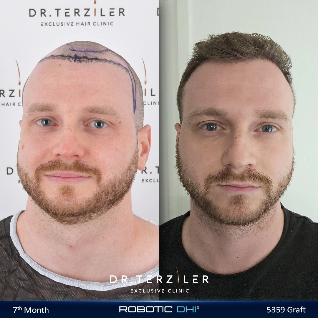 Greffe de cheveux 5000 greffons avant après vue de face chez Dr. Terziler à Istanbul