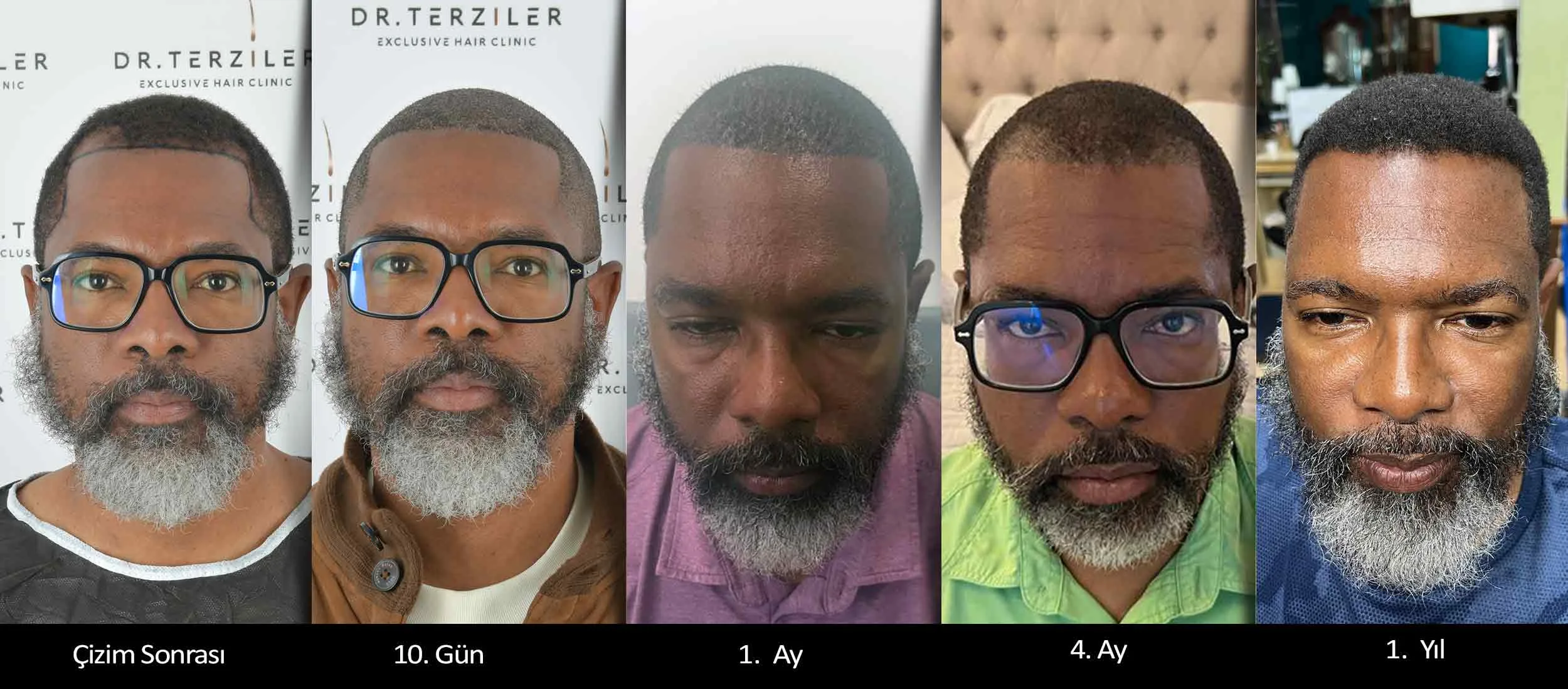 Afro Robotic DHI hair transplant Turkey timeline from hairline design to day 10 month 1 month 4 and one year result for Black male patient