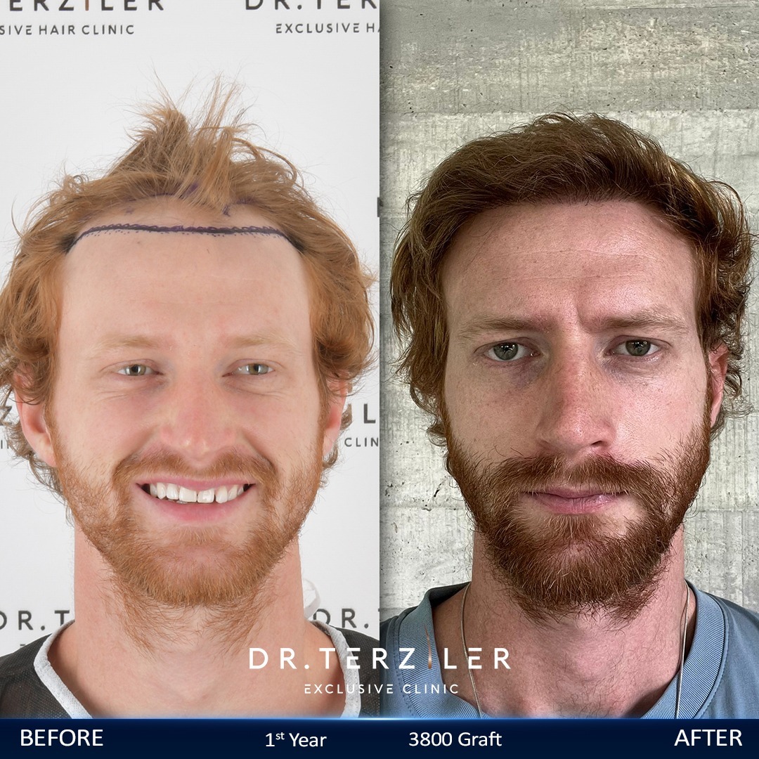 3,800 Graft Hair Transplant Turkey Cost — Switzerland Result 3,800 graft hair transplant Turkey cost before and after, Switzerland patient
