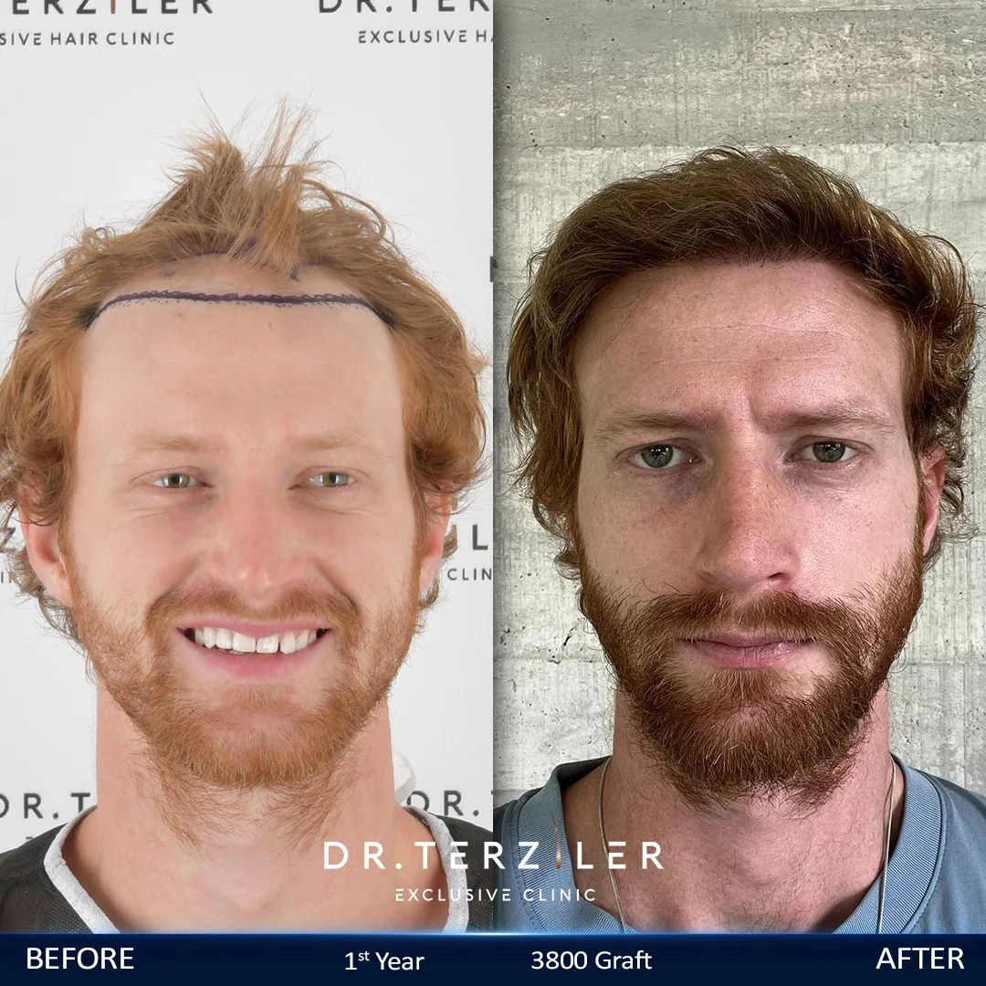 3,800 Graft Hair Transplant Turkey Cost — Switzerland Result 3,800 graft hair transplant Turkey cost before and after, Switzerland patient
