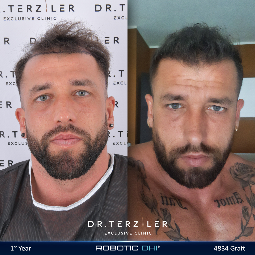 Robotic DHI hair transplant before and after result of international patient Emmanuel at Dr. Terziler Exclusive Clinic Istanbul, doctor-led implantation and natural frontal hairline density by Dr. Servet Terziler