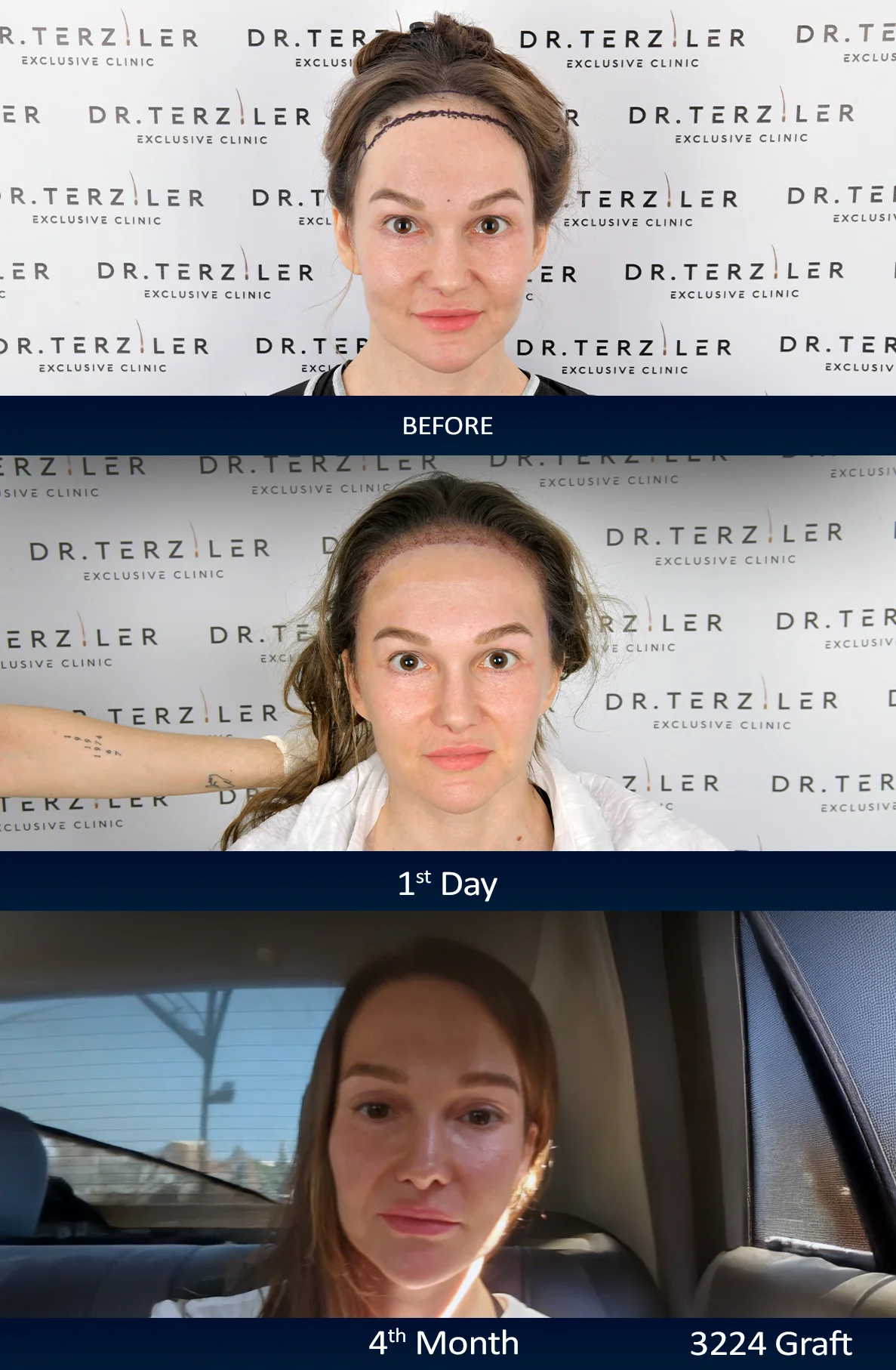 Olga female hair transplant before and after frontal hairline healing process, shaven-free female DHI at Dr. Terziler the best hair transplant clinic in Turkey