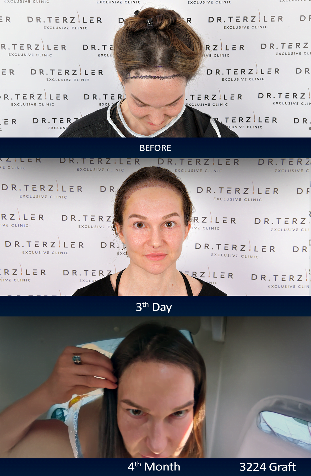 Olga female hair transplant in Turkey timeline before, day 1, day 3 and 4th month 3224 graft no-shave DHI result at Dr. Terziler Exclusive Clinic