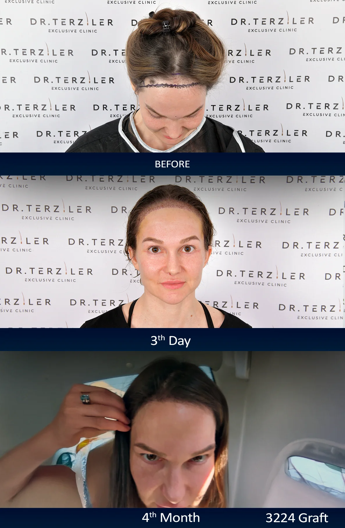 Olga female hair transplant in Turkey timeline before, day 1, day 3 and 4th month 3224 graft no-shave DHI result at Dr. Terziler Exclusive Clinic