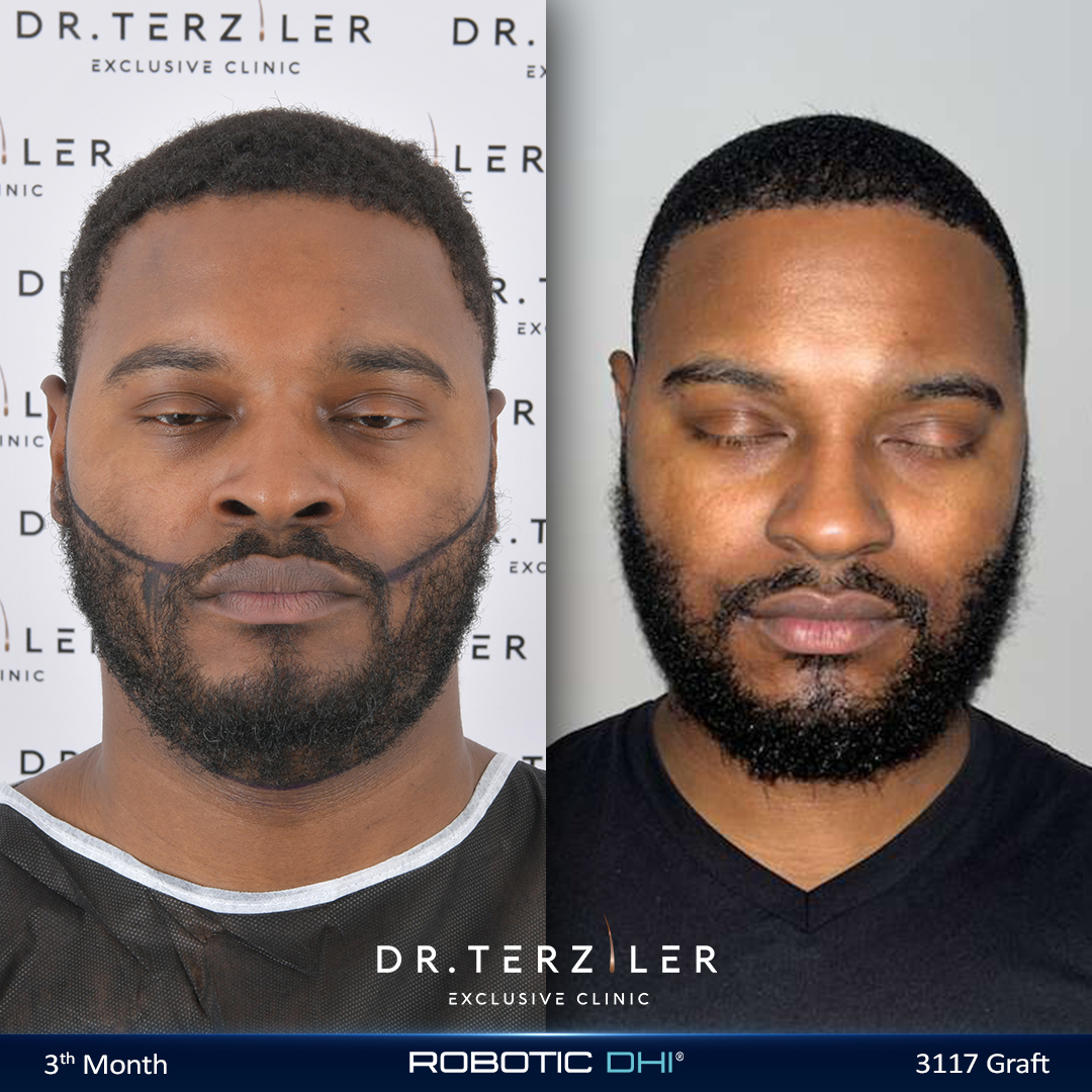 Afro beard transplant before after in Turkey, 3117 graft Robotic DHI cheek and jaw result at Dr. Terziler Exclusive Clinic