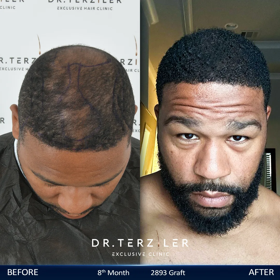 Afro hair transplant Turkey before and after result for Marcus J., a USA patient treated with Modified DHI, 2893 grafts, 8 month result.