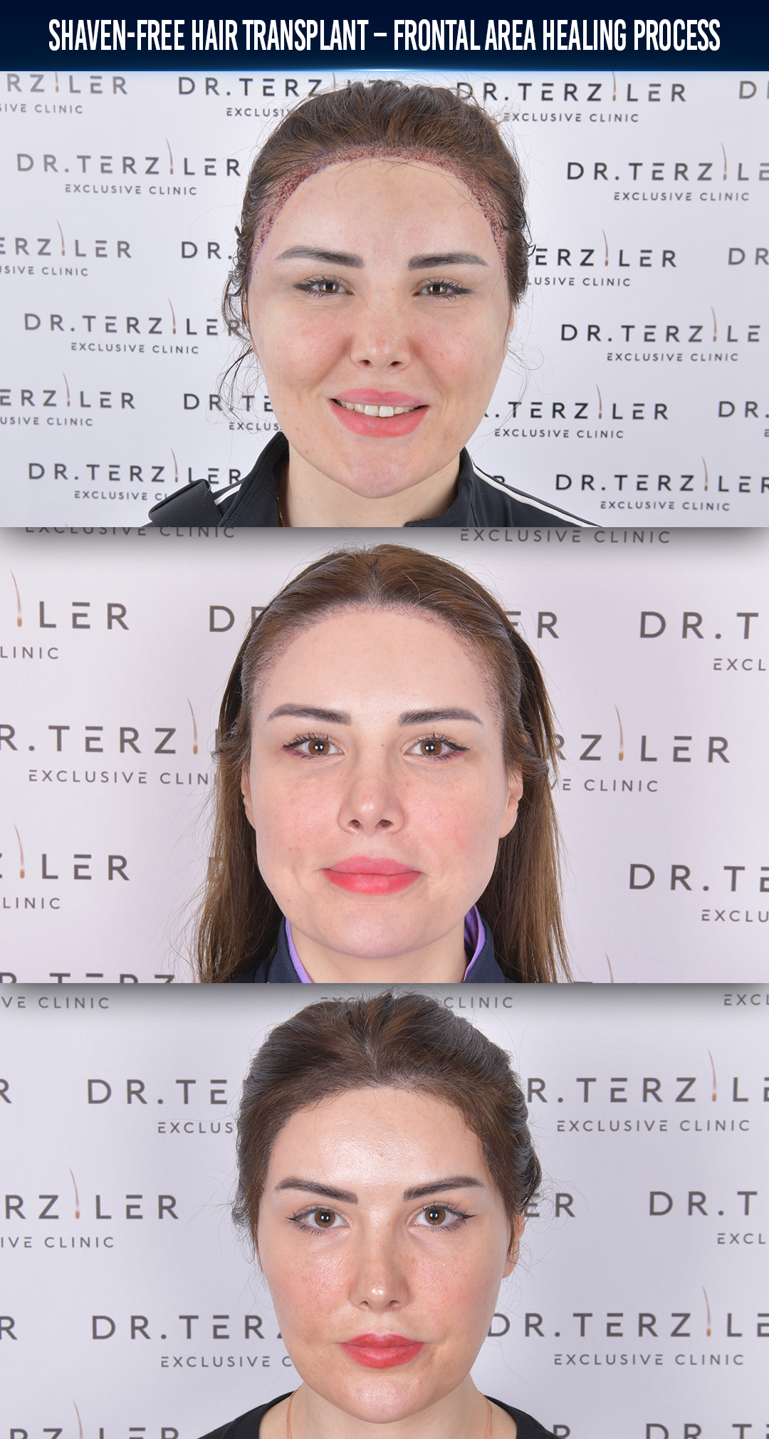Aisha woman hair transplant in Turkey before and after natural hairline result at Dr. Terziler Exclusive Clinic, best female hair transplant clinic in Turkey