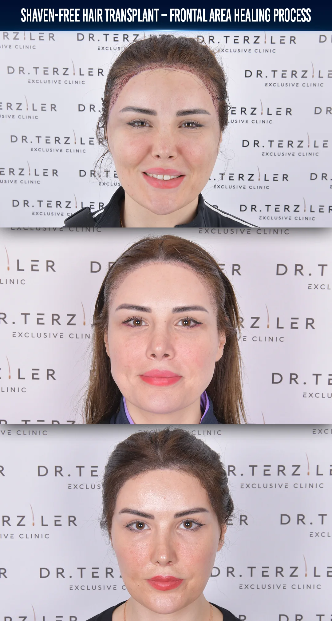 Aisha woman hair transplant in Turkey before and after natural hairline result at Dr. Terziler Exclusive Clinic, best female hair transplant clinic in Turkey