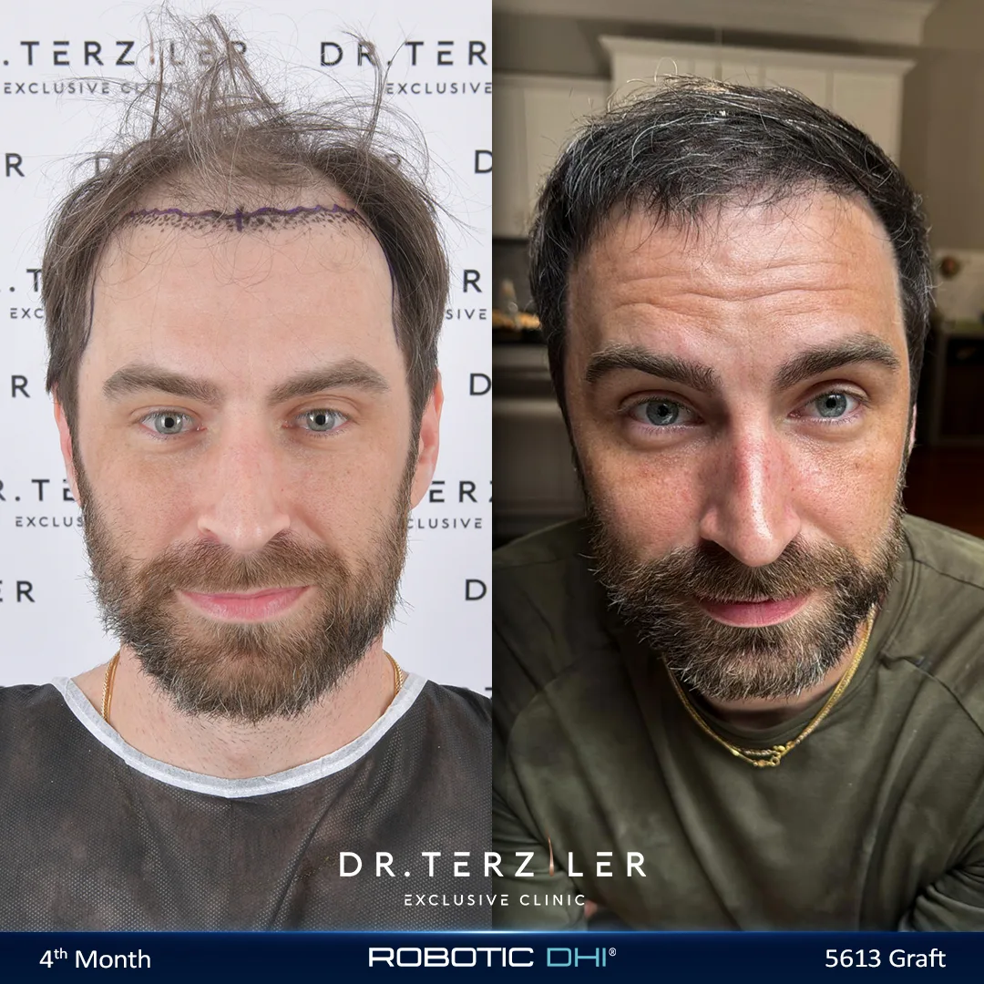 Transplante capilar DHI: antes y despu&eacute;s; restauraci&oacute;n de la l&iacute;nea capilar masculina con densidad total en la Cl&iacute;nica Exclusiva del Dr. Terziler de Estambul