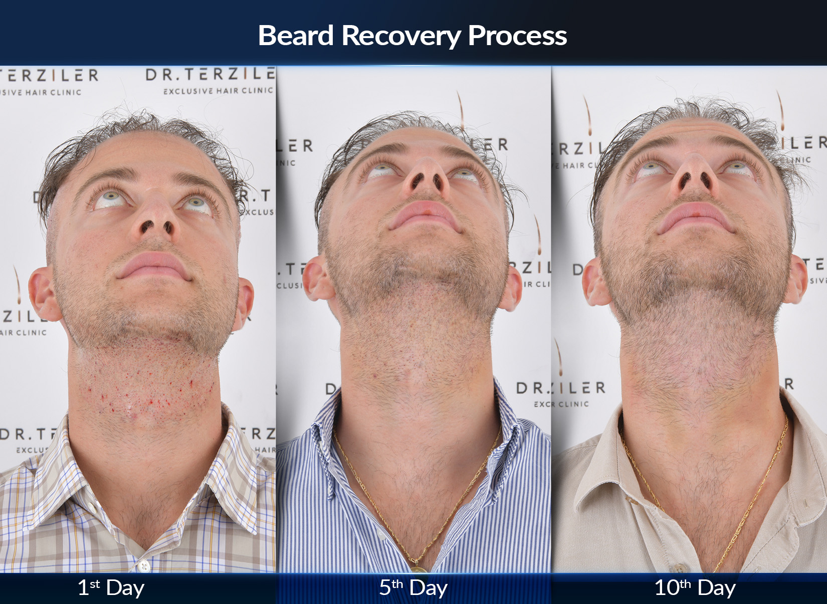 Beard transplant recovery process in Turkey, healing stages after facial hair restoration at Dr. Terziler Exclusive Clinic
