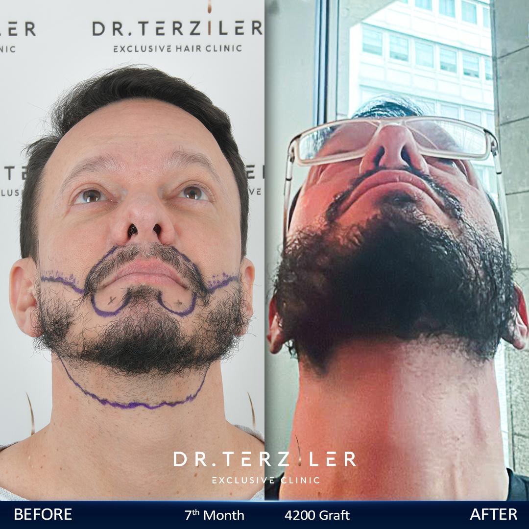 Beard transplant before after front view in Turkey, patchy beard restored at Dr. Terziler Exclusive Clinic