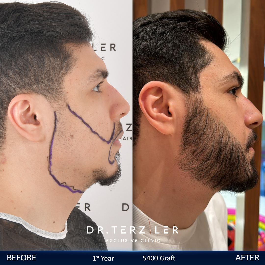 Beard restoration in Turkey before after second angle, defined beard border at Dr. Terziler Exclusive Clinic