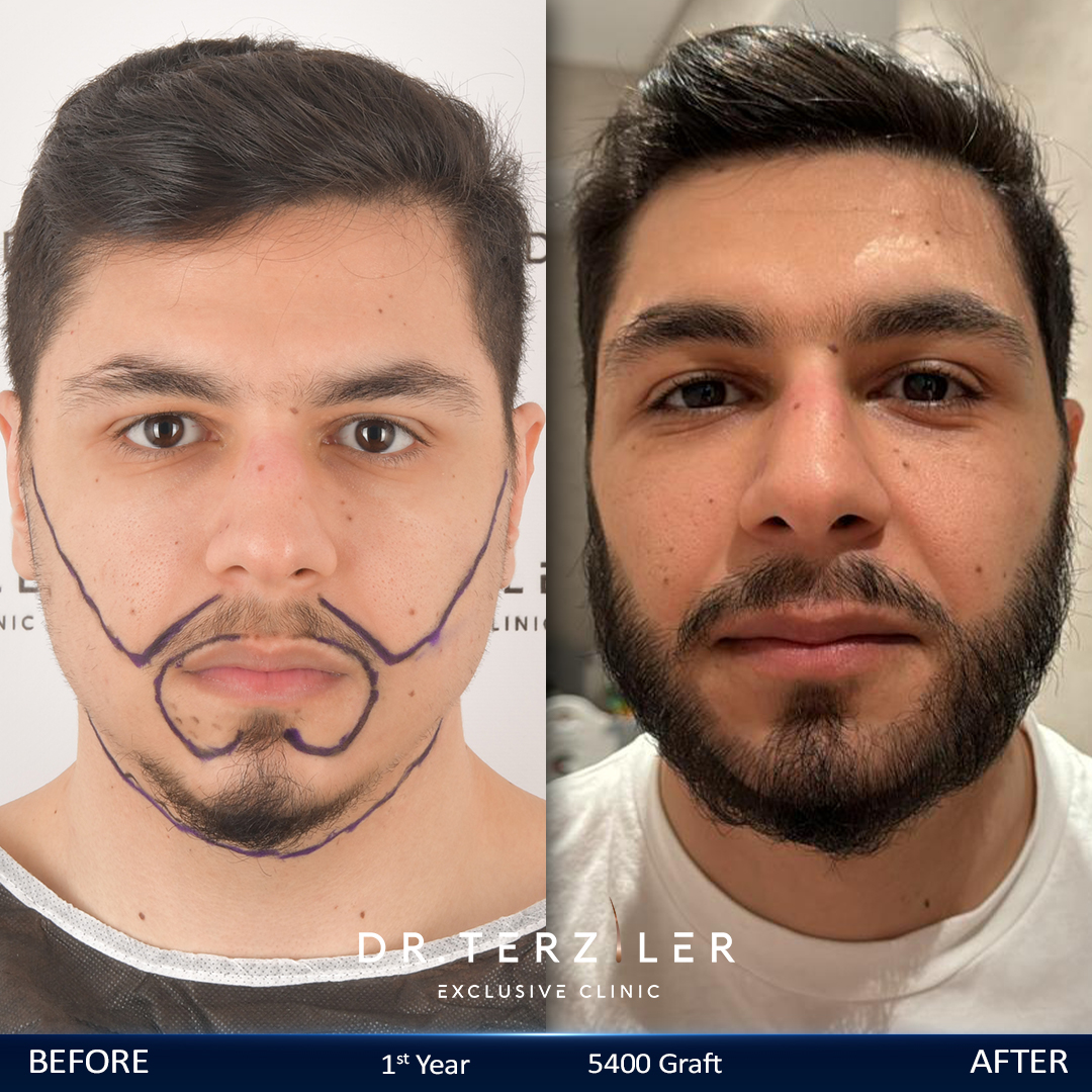 Beard transplant before after in Turkey, jawline and goatee density result at Dr. Terziler Exclusive Clinic