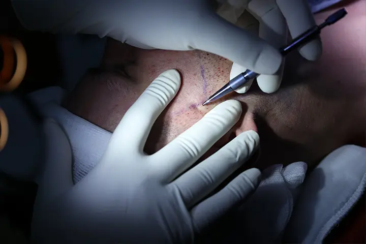 Beard transplant process in Turkey, Robotic DHI implantation on the cheek line at Dr. Terziler Exclusive Clinic