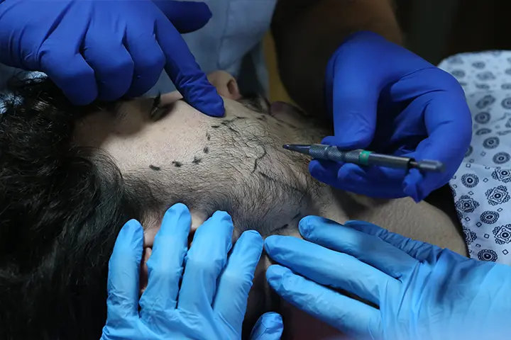 Beard transplant operation in Turkey, micro-FUE donor extraction step at Dr. Terziler Exclusive Clinic