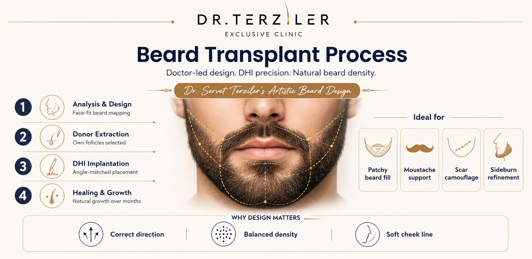 Beard transplant process infographic Turkey, micro-FUE to Robotic DHI and Day 0 to Month 12 recovery timeline at Dr. Terziler Exclusive Clinic