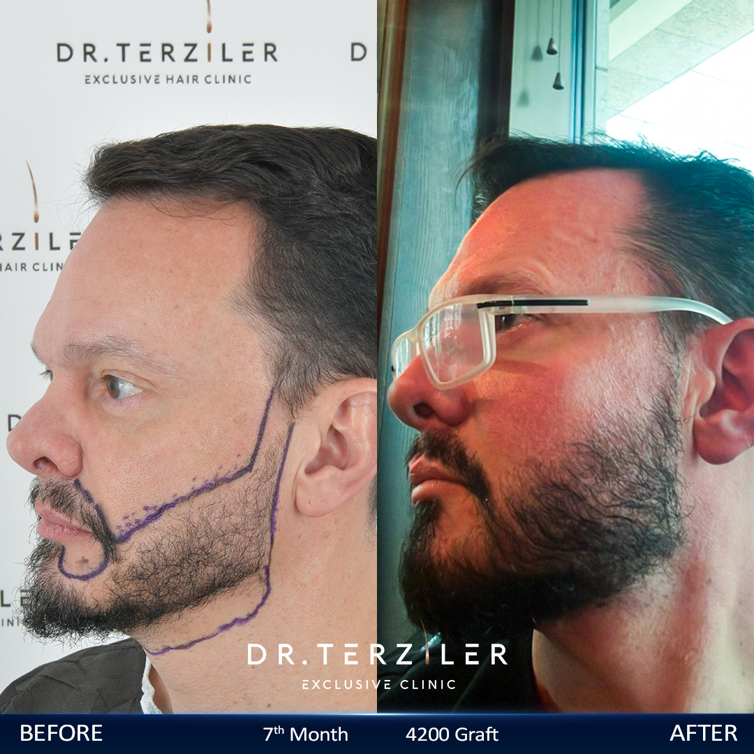 Beard transplant Turkey before after side profile, natural mustache and cheek line density at Dr. Terziler Exclusive Clinic